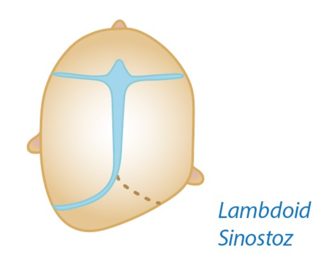 posterior plagiosefali